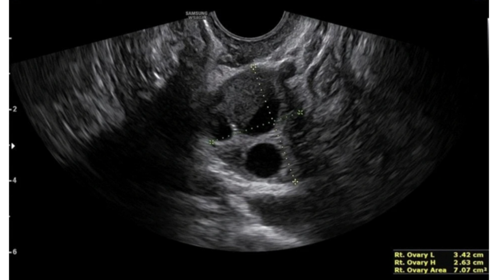 Endometrioma con evidencia del característico doble nivel líquido-líquido. Dentro de la formación, se pueden observar puntos hiperecogénicos, síntoma de acumulación de hemosiderina.