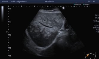 Ecografía de segmentos hepáticos derechos, reconociéndose imágenes focales ecogénicas confluentes, de distribución perivascular, sin efecto de masa.