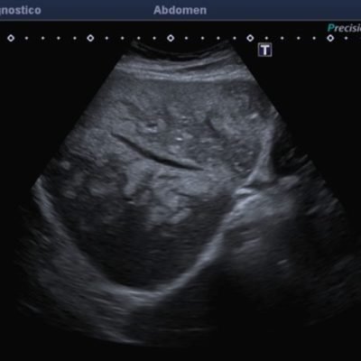 Ecografía de segmentos hepáticos derechos, reconociéndose imágenes focales ecogénicas confluentes, de distribución perivascular, sin efecto de masa.