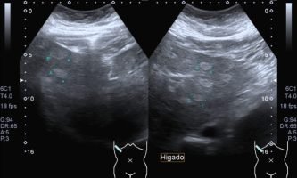 Figura 10. Ecografía de segmentos hepáticos izquierdos, observándose múltiples focos ecogénicos, que resulta difícil su caracterización por este método de estudio.