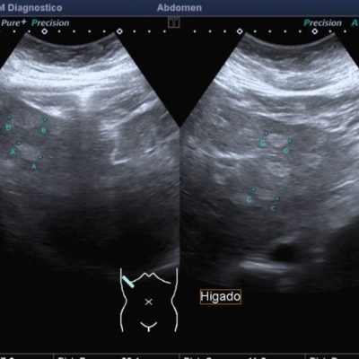 Figura 10. Ecografía de segmentos hepáticos izquierdos, observándose múltiples focos ecogénicos, que resulta difícil su caracterización por este método de estudio.