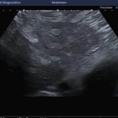 Figura 11. Ecografía de domo hepático de mismo paciente, apreciando un importante numero de lesiones focales ecogénicas de pequeño tamaño.