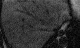 Figura 12. RM de abdomen del mismo paciente en pulsos fuera de fase, con áreas focales de baja señal, en relación a acúmulos grasos intracelulares.