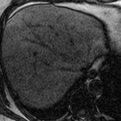 Figura 12. RM de abdomen del mismo paciente en pulsos fuera de fase, con áreas focales de baja señal, en relación a acúmulos grasos intracelulares.
