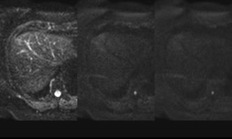 Figura 13. RM. Secuencias difusión del mismo paciente con valores de b, 0-400-800, sin focos de restricción que sugieran la presencia de metástasis.