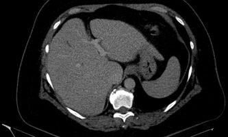 Figura 14. TC hepática del mismo paciente en tiempo portal post contraste endovenoso, sin evidencia de imágenes sospechosas.