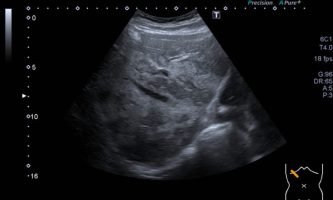 Figura 4. Ecografía del lóbulo derecho observándose calibre habitual de venas supra hepáticas, sin efecto de masa de lesiones ecogénicas confluentes adyacentes.