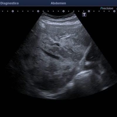 Figura 4. Ecografía del lóbulo derecho observándose calibre habitual de venas supra hepáticas, sin efecto de masa de lesiones ecogénicas confluentes adyacentes.