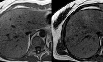 Figura 5. RM axial sector medio del hígado A. Secuencias en fase sin alteración de la señal hepática. B. Secuencias en fuera de fase, donde se aprecia menor intensidad de señal en los sectores donde hay acúmulos de grasa intracelular, con distribución a predominio perivascular.