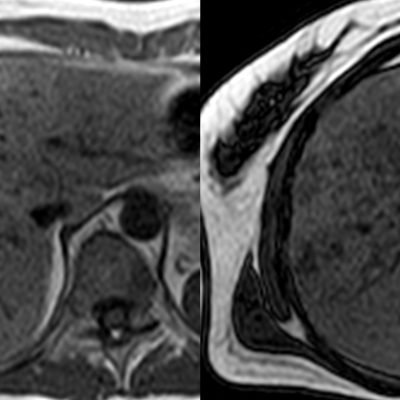 Figura 5. RM axial sector medio del hígado A. Secuencias en fase sin alteración de la señal hepática. B. Secuencias en fuera de fase, donde se aprecia menor intensidad de señal en los sectores donde hay acúmulos de grasa intracelular, con distribución a predominio perivascular.
