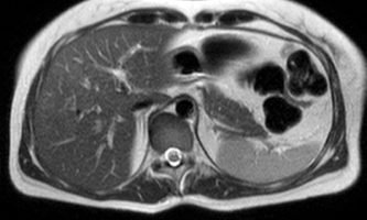 Figura 6. RM potenciada en pulsos T2, observándose un parénquima homogéneo, sin lesiones focales.