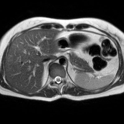 Figura 6. RM potenciada en pulsos T2, observándose un parénquima homogéneo, sin lesiones focales.