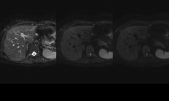 Figura 7. RM en secuencias difusión con valores de b, 0-400-800, sin áreas focales ni difusas de restricción que sugieran la presencia de lesiones benignas hepáticas, infecciosas o metastásicas.