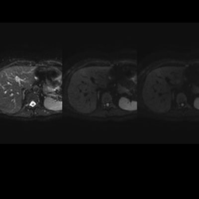 Figura 7. RM en secuencias difusión con valores de b, 0-400-800, sin áreas focales ni difusas de restricción que sugieran la presencia de lesiones benignas hepáticas, infecciosas o metastásicas.