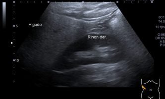 Figura 8. Ecografía hepática, con aumento difuso de la ecogenicidad del parénquima. Se reconoce la diferencia de ecogenicidad con la corteza renal adyacente.