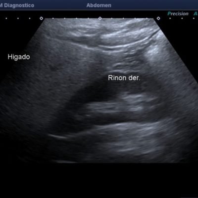 Figura 8. Ecografía hepática, con aumento difuso de la ecogenicidad del parénquima. Se reconoce la diferencia de ecogenicidad con la corteza renal adyacente.