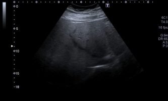 Figura 9B. Eco-Doppler de mismos segmentos, reconociendo la dirección y patrón habitual de la vena suprahepática media.