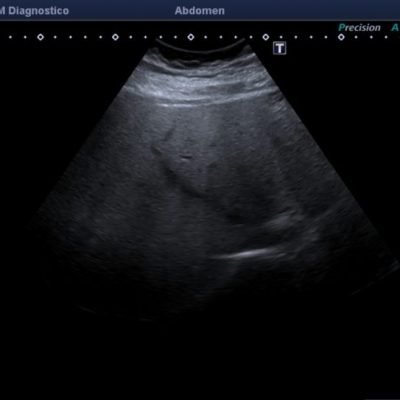 Figura 9B. Eco-Doppler de mismos segmentos, reconociendo la dirección y patrón habitual de la vena suprahepática media.