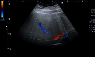 Figura 9a. Eco-Doppler de mismos segmentos, reconociendo la dirección y patrón habitual de la vena suprahepática media.