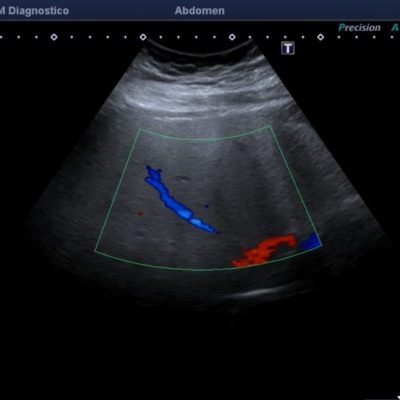 Figura 9a. Eco-Doppler de mismos segmentos, reconociendo la dirección y patrón habitual de la vena suprahepática media.