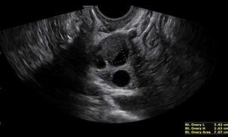 Endometrioma con evidencia del característico doble nivel líquido-líquido. Dentro de la formación, se pueden observar puntos hiperecogénicos, síntoma de acumulación de hemosiderina.