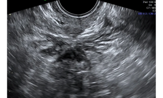 Nódulo hipoecoico de la porción rectosigmoidea que oblitera el Douglas. A este nivel, se puede observar el "signo de deslizamiento", signo del deslizamiento de las estructuras unas sobre otras que no se presenta en el caso de la endometriosis.