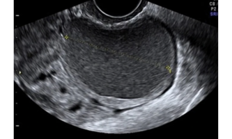 Quiste endometriósico, con parénquima regular en la periferia, denominado “signo de la media luna”, característico de las lesiones benignas. Ausencia de vascularización intralesional.